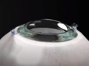 Новая синтетическая роговица позволяет слепому полностью восстановить зрение