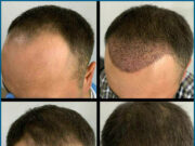 Пересадка волос: безопасный и эффективный FUE метод