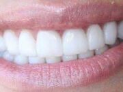 Керамические виниры: подарите себе улыбку